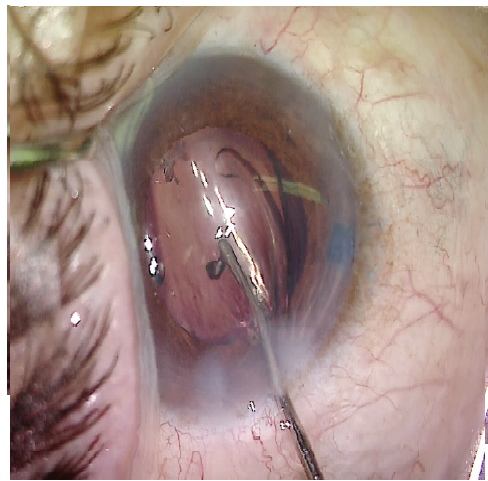 Topical (without injection) Cataract Surgery