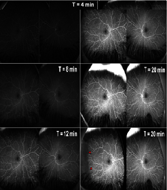 FFA (Fundus Fluorescein Angiography) for Retinal Diseases