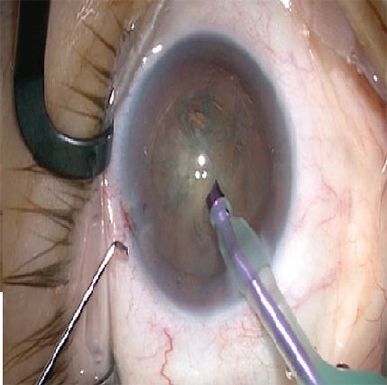 MICS phaco surgery for cataract